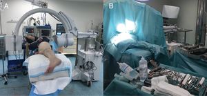 Cadera izquierda. A) Colocación del paciente y de la radioscopia intraoperatoria. B) Montaje del campo quirúrgico.