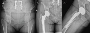 Cadera derecha. Abordaje Superpath. A) Radiología preoperatoria. B y C) Control radiológico a los 3 meses de la cirugía.