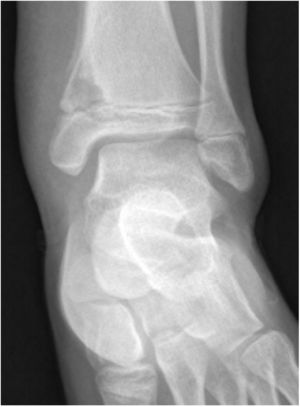 Radiografía convencional que muestra lesión lítica metáfisis a nivel de tibia distal.