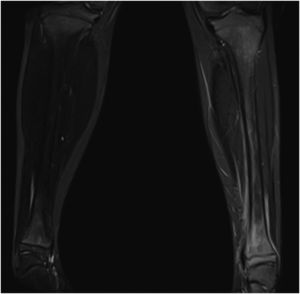 Afectación amplia de la tibia izquierda observada tras punción ósea en RM. Se aprecia afectación de la totalidad del hueso con lesión principal a nivel de metáfisis distal y edema de partes blandas adyacentes.