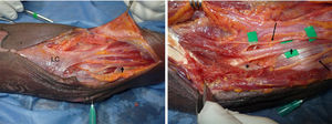Disección tercio proximal antebrazo. Distal: izquierda. LC: lacertus fibrosus, por debajo está el NM (flecha negra corta). Derecha: levantado el LC se observa el NM penetrando por debajo de la fascia profunda de PT (asterisco). Se observan ramas para el músculo PT (flechas negras largas). La arteria braquial se encuentra lateral al NM.