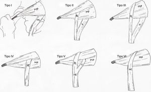 Tipos de variaciones anatómicas del músculo piriforme y nervio ciático según la clasificación de Beaton y Anson (1937). PC: nervio peroneo común; T: nervio tibial. Fuente: dibujo realizado por Carla Marco siguiendo dicha clasificación. MP: músculo piriforme; NC: nervio ciático.