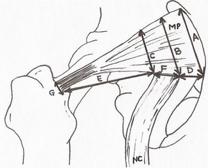 Medidas antropométricas. A: amplitud del músculo piriforme en su origen. B y C: amplitud del músculo piriforme a nivel medial y lateral de la salida del nervio ciático. D: distancia entre el origen del músculo piriforme y la salida del nervio ciático. E: distancia entre la salida del nervio ciático y el trocánter mayor del fémur. F: diámetro del nervio ciático en su salida. G: diámetro del tendón del músculo piriforme antes de la inserción. MP: músculo piriforme; NC: nervio ciático.