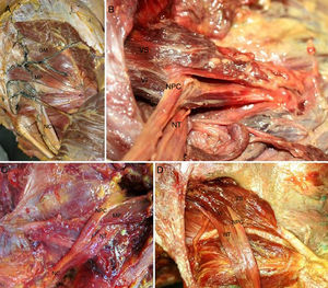 A) Anatomía normal de la región glútea. Vasos glúteos inyectados. Corresponde a la variación anatómica tipo I. B) Variación anatómica tipo II. Nervio peroneo común atravesando músculo piriforme. C) Variación anatómica tipo III. D) Variación anatómica tipo II (izquierda y derecha). En la figura de la derecha se observan 2 vientres musculares del músculo piriforme. El inferior tiene origen tendinoso. GM: glúteo medio; MP: músculo piriforme; NC: nervio ciático; NPC: nervio peroneo común; NT: nervio tibial; VI: vientre inferior del músculo piriforme; VS: vientre superior del músculo piriforme.