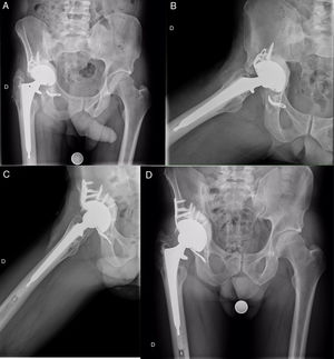 Paciente de 40 años con artritis reumatoide en el cual se implantó una prótesis total de cadera primaria en 2003; posteriormente precisó recambio de cotilo con injerto óseo por aflojamiento aséptico en 2008; en 2010 necesitó otro recambio de cotilo con injerto óseo e implantación de un anillo de refuerzo tipo Bat-Cup por aflojamiento aséptico con protrusión acetabular, el cual también fracasó en 2012 con rotura del implante y aflojamiento aséptico, motivo por el cual se colocó el Cup-Cage. En las imágenes A y B se muestran las radiografías en las proyecciones anteroposterior y axial, respectivamente, donde se puede observar el aflojamiento acetabular con rotura de la inserción isquiática del anillo. Las imágenes C y D corresponden al control radiográfico en las proyecciones axial y anteroposterior a los 3 años y medio de la implantación del Cup-Cage, con una correcta integración del injerto acetabular y una buena posición del implante.
