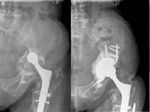 A) Paciente con defecto acetabular masivo y discontinuidad pélvica. B) Se realizó recambio acetabular con implantación de cotilo de metal trabecular asociado a injerto óseo y Cup-Cage.