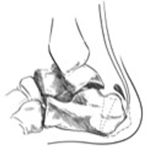 Las líneas de puntos muestran la osteotomía calcánea de cuña de sustracción dorsal para la tríada de Haglund. El objetivo de esta osteotomía es elevar el punto de inserción del tendón de Aquiles y anteriorizar la tuberosidad posterosuperior del calcáneo. El acortamiento del calcáneo y la elevación del punto de inserción de Aquiles reduciría la tensión en la inserción del tendón de Aquiles.