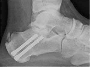 Radiografía postoperatoria de una osteotomía calcánea con cuña de sustracción dorsal fijada con 2 tornillos canulados de 6,5mm. Puede verse cómo las calcificaciones habitualmente se mantienen tras la cirugía ya que el tendón no es desbridado.