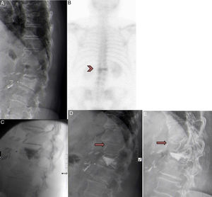 A) Mujer de 71 años, con fractura D12. B) Intervenida previamente de cirugía abdominal. Gammagrafía que muestra hipercaptación en fractura tras 12 meses. C) Paciente incluida en el grupo IL. Se realiza una vertebroplastia en D12, con fuga de cemento al disco caudal. D) Se objetiva una mejoría de 4 puntos en la EVA. Un mes tras la vertebroplastia la paciente presenta un dolor dorsal intenso tras flexión de columna. La radiografía muestra una nueva fractura por compresión en D11 que fue tratada mediante tratamiento conservador con corsé y analgesia. E) Después de 3 meses, la fractura había consolidado con un aplastamiento del 30%. La paciente se encuentra en este momento asintomática.