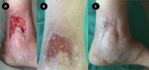 Evolución favorable de la herida, inicialmente solo con sevoflurano (A) y posteriormente con el tratamiento multimodal (B) hasta la curación completa (C).