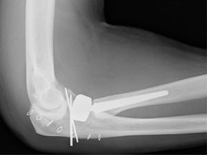 Fractura de cúpula radial tratada con prótesis bipolar. Reconstrucción de la coronoides con agujas de Kirschner.