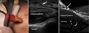 A) Imagen intraoperatoria. B) Imagen ecográfica de rotura de tendón distal de bíceps (flecha) en corte longitudinal. C) Imagen de resonancia del mismo paciente con rotura completa de tendón distal de bíceps en corte sagital.