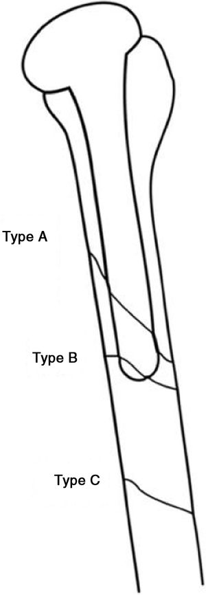 Esquema de los tipos de fracturas periprotésicas según Wright y Cofield6.
