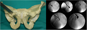 Primera osteotomía; osteotomía púbica inmediatamente después de la lágrima. Supervisado por radiografías de pelvis antero-posterior.