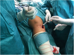 Incisión quirúrgica para la obtención de los tendones isquiotibiales.