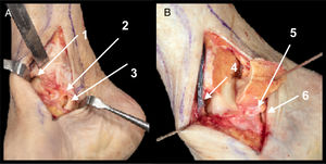 A. Osteotomía de maléolo tibial. Sección de deltoideo superficial y profundo (fascículo tibiotalar anterior y fascículo tibionavicular) y de cápsula articular (1). Fascículo tibiotalar posterior del ligamento deltoideo profundo (2). Tendón tibial posterior (3). B. Exposición de cúpula astragalina interna. Vena safena mayor inyectada con látex (4) y fascículos posteriores de ligamento deltoideo profundo (5) y tendón tibial posterior (6).