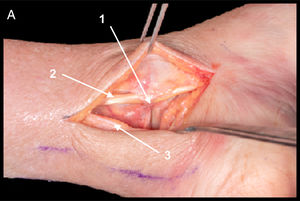 PM. Campo de visualización de proceso posterior del astrágalo y articulación tibiotalar (1). Abordaje entre tendón tibial posterior (2) y flexor largo de los dedos (3) para evitar lesión de paquete neurovascular.