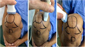 Posición de la pierna y el transductor para la toma de ecografía 1a: Sonda en disposición transversal al eje largo de la rodilla, medición de los puntos A, B y C. 1b: Sonda de forma longitudinal al eje largo de la rodilla sobre el cóndilo medial, punto D. 1c: Sonda de forma longitudinal al eje largo de la rodilla sobre el cóndilo lateral, punto E.