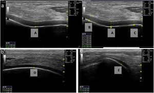 Medidas ecográficas del cartílago articular 2a: Medición del cartílago femoral en los puntos (A, B, C) 2b: Medición del cartílago femoral en el punto D. 2c: Medición del cartílago femoral en el punto E.