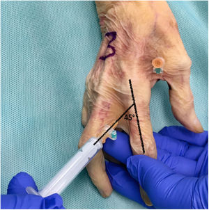 Inyección a través de la piel dorsal de la comisura digital realizada en cada dedo manteniendo la articulación metacarpofalángica ligeramente flexionada y dirigiendo la aguja hacia la cabeza del metacarpiano con un ángulo de 45° con respecto al eje del dedo.