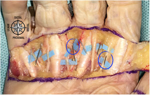 Espécimen número 5. Se identificaron 2 lesiones: nervio digital cubital del dedo índice y arteria digital radial del dedo anular.