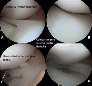 Imágenes de artroscopia de rodilla derecha antes (A y B) y después (C y D) de la remodelación del menisco discoideo completo medial.