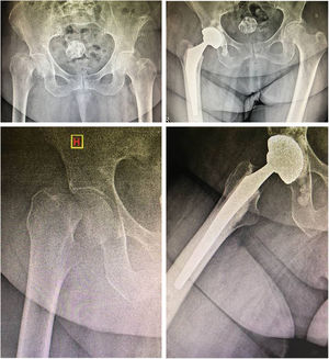 Paciente femenino de 86 años. A) Radiografía anteroposterior de ambas caderas. B) Radiografía lateral de cadera derecha. C) Radiografía de ambas caderas a último seguimiento. D) Radiografía lateral de cadera derecha a último seguimiento.
