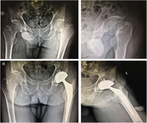 Paciente femenino de 90 años. A) Radiografía anteroposterior de ambas caderas. B) Radiografía lateral de cadera izquierda. C) Radiografía de ambas caderas a último seguimiento. D) Radiografía lateral de cadera izquierda a último seguimiento.