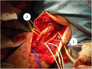 Imagen quirúrgica donde se observan referenciadas las estructuras vasculonerviosas (1 nervio cubital; 2 nervio mediano y arteria braquial) una vez ha sido resecado el tumor (caso 4).