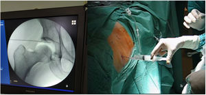 Imágenes intraoperatorias. A) Aerograma intraoperatorio. B) Introducción aire intraarticular para comprobar situación intraarticular del introductor.