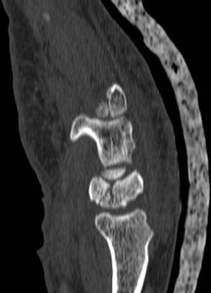 Corte sagital de TC en el que se observa una fractura transversal del cuerpo del semilunar sin signos de consolidación.
