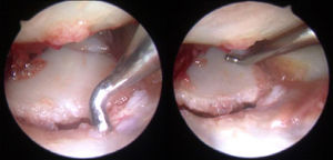 Imágenes artroscópicas desde visión mediocarpiana donde se observa el trazo de fractura transverso a nivel del cuerpo del semilunar.