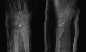 Radiografía simple de control postoperatorio inmediato en proyecciones posteroanterior y lateral, donde se observa una correcta reducción y la colocación del tornillo de osteosíntesis y del anclaje para la sutura del ligamento escafolunar.