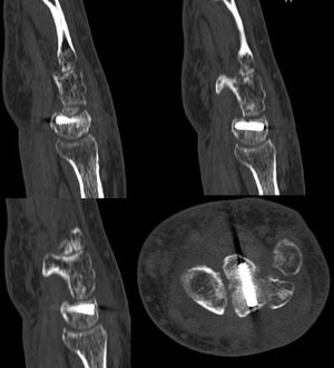 Imágenes postoperatorias de TC donde se observa la correcta reducción de la fractura y la colocación del tornillo de osteosíntesis.