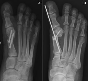 A) Osteotomía en chevron percutánea, fijación con dos tornillos. B) Osteotomía de Bosch con la colocación de tornillo y aguja de Kirschner.
