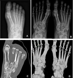 Diagnóstico por imagen en pie derecho. A) Radiografía inicial en descarga. B) Radiografía en carga realizada ambulatoriamente donde se incluyen ambos pies. C-D) Imagen TC; corte axial y reconstrucción donde de aprecia la diástasis respecto al lado sano.