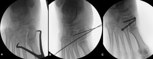 A) Reducción cerrada guiada por escopia. B-C) Síntesis con tornillos HCS canulados 4,5 mm (Headless Compression Screw (HCS, Synthes Inc, West Chester, PA, USA).