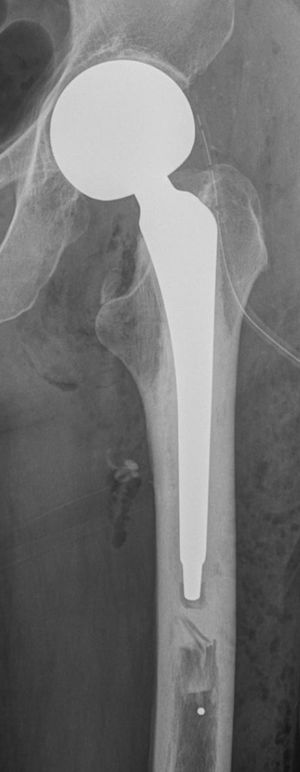 Cementograma en prótesis total de cadera. Imagen radiopaca posterointerna que insinúa el recorrido de una vena nutricia femoral, dibujando las valvas de la misma.