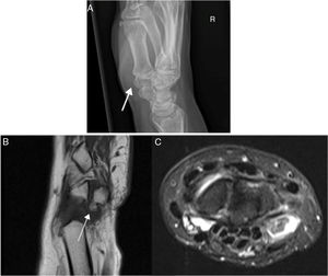 A) Radiografía Simple. Imagen en exofítica con continuidad con la cortical del hueso adyacente con una base ancha a nivel del pisiforme. B-C) Resonancia magnética del carpo. Osteocondroma solitario pediculado en el pisiforme siendo lesión exofítica con continuidad córticomedular en polo proximal de 5x5 mm rodeada de líquido sinovial con estructuras tendinosas y ligamentosas correctas.
