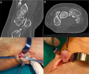 A-B) Tomografía computarizada del carpo. Se observa exostosis proximal de pisiforme con artrosis de articulación piso-piramidal con cuerpo libre en interlínea articular distal en la izquierda. C-D) Pieza quirúrgica. En la imagen C se visualiza cara volar de hueso pisiforme con exóstosis en polo inferior; en la imagen D se observa cara dorsal del mismo.