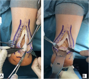Desbridamiento y calcaneoplastia. A) Nótese el aspecto degenerado del tejido en la inserción del calcáneo. B) La calcaneoplastia se inicia con sierra oscilante y se finaliza con periostotomo.