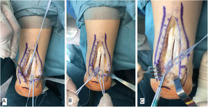 Reanclaje en doble hilera con arpones y cinta trenzada de alta resistencia. A) Anclaje de sendos arpones sobre la tuberosidad del calcáneo, atravesando el tendón. B) Configuración en doble hilera cruzada. C) Anclaje distal con arpón sin nudo.