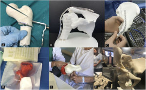 Biomodelos 3D en COT. A) Planificación preoperatoria. B) Premoldeado de placas. C) Ayuda intraoperatoria. D) Esterilizado para uso quirúrgico. E) Comunicación médico-paciente. F) Formación médica.