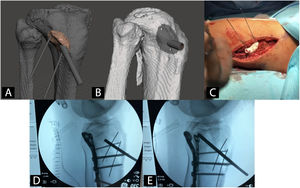 Ejemplo de guía quirúrgica paciente-específica para la elevación de fragmento articular hundido en fractura de meseta tibial. A) Modelo CAD y planificación virtual de la guía. B) Modelo CAD de la guía quirúrgica. C) Intervención con guía quirúrgica paciente-específica. D) Radioescopia previa a elevación de fragmento articular. E) Radioescopia durante elevación de fragmento articular.