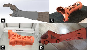 Ejemplo de órtesis de muñeca fabricada mediante impresión 3D. A) Renderizado virtual tras escaneado de superficie. B) Modelo CAD de órtesis personalizada C) Impresión 3D mediante tecnología FDM en material PLA. D) Correcta aplicación de la órtesis.