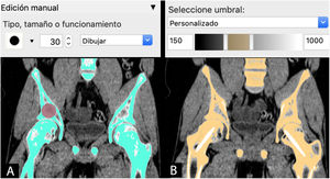 Herramientas de segmentación en Invesalius (Centro de Tecnologia da Informação Renato Archer, Campinas, SP, Brasil). A): Manual tipo pincel. B) Automática tipo umbral.