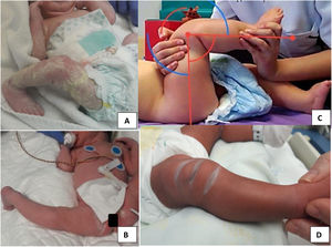 Imágenes de pacientes con luxación congénita de rodilla en diferentes grados. A y B: el paciente recién nacido presenta una hiperextensión marcada. C: paciente que consigue realizar una flexión pasiva de 90°. D: imagen de los característicos pliegues en la cara anterior.