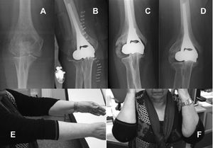 Caso 1. A) Radiografía inicial. B, C y D) Control radiológico a las 3 semanas, 1 año y a los 8 años de la implantación de la prótesis. E y F) Resultado clínico al final del seguimiento.