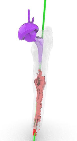 En morado, vástago movilizado (exeter de longitud 95 mm). En rojo, el cemento que impide implantar un vástago mayor. En verde, diseño del trayecto deseado de la broca para retirar cemento y permitir alojar un vástago mayor.