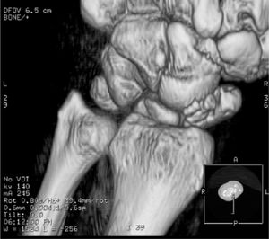 Imagen 3DVR de TC de muñeca izquierda: alteración morfológica del escafoides, multifragmentado, con desviación hacia dorsal del semilunar (DISI).